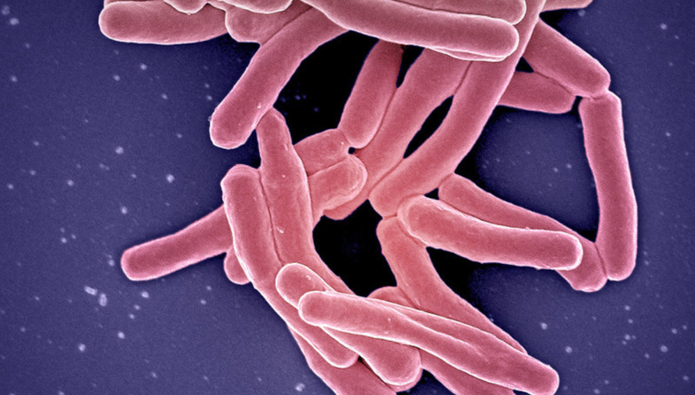 Breakthroughs hailed in childhood TB prevention