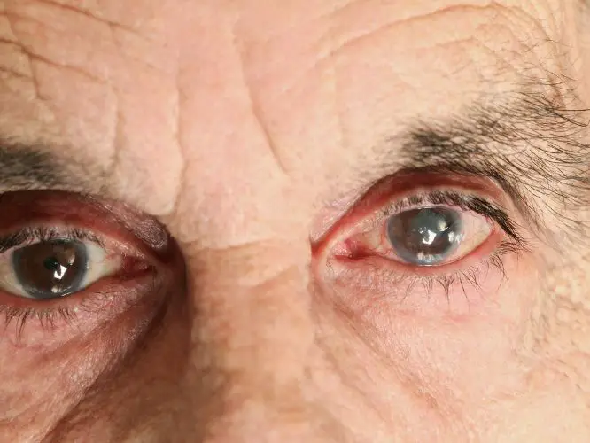 The Signs & Symptoms Of Glaucoma: What To Do